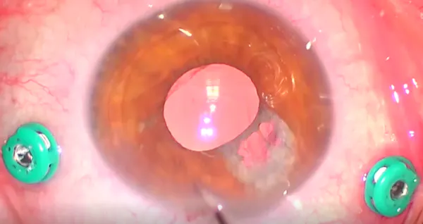 Posterior Capsular Tear thumbnail
