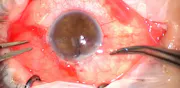 Aphakic Pupil Reconstruction