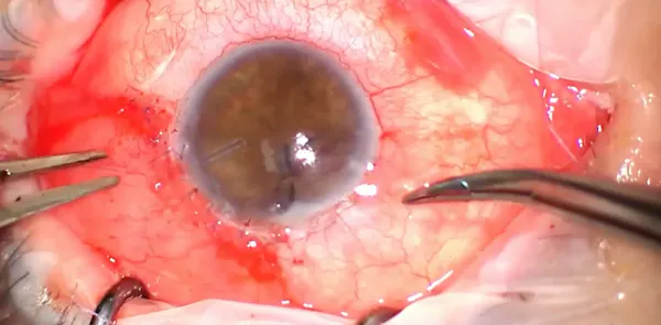 Aphakic Pupil Reconstruction thumbnail