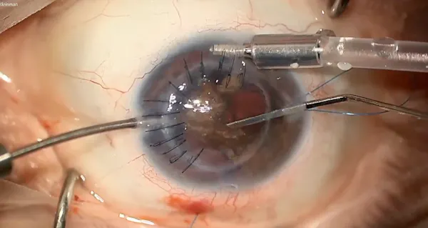Traumatic Iridodialysis and Aphakia thumbnail