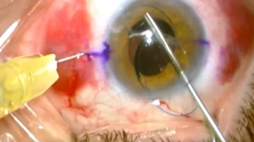 Laser-Assisted Repositioning