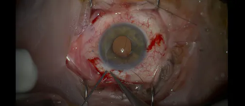 Cyclodialysis Cleft Repair