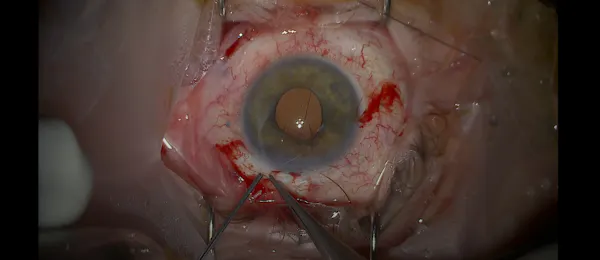 Cyclodialysis Cleft Repair thumbnail