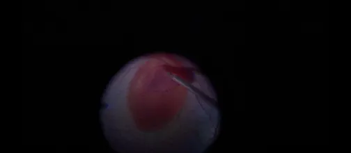 Sub-ILM Hemorrhage in the Macula