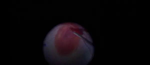 Sub-ILM Hemorrhage in the Macula thumbnail