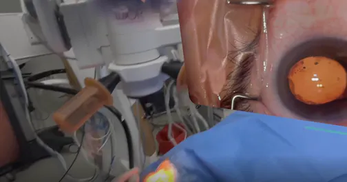 Phacoemulsification With Real-Time Remote Collaboration