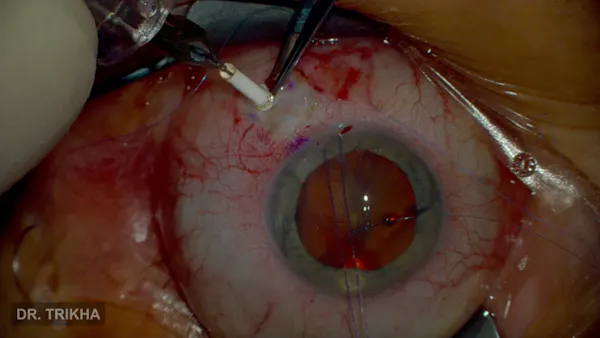 Encelto Implant Surgery thumbnail