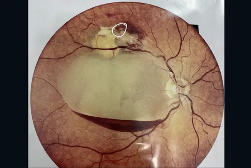 Retinal Arterial Microaneurysms Associated with Preretinal Macular Hemorrhage