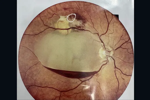 Retinal Arterial Microaneurysms Associated with Preretinal Macular Hemorrhage thumbnail