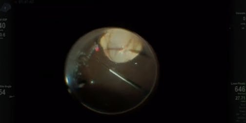 Coloboma Retinal Detachment Repair
