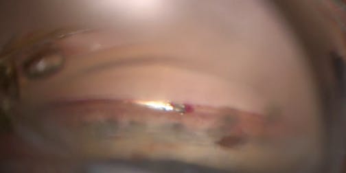 Hydrus Adjustment With Blanching - Eyetube