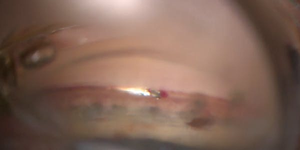Hydrus Adjustment With Blanching thumbnail