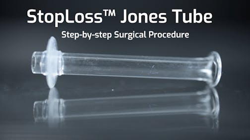 StopLoss<sup>™</sup> Jones tube | CDCR | Step-by-step Procedure