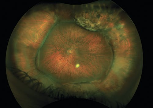 Myopic Refraction With Scleral Buckle image
