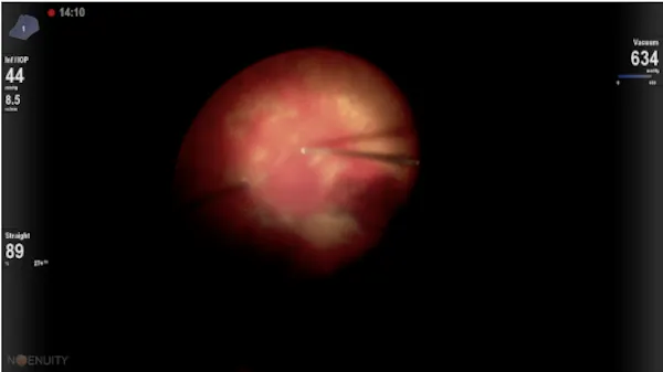 Dr. Berrocal 27G HyperVit TRD VH w/ DATAFUSION thumbnail