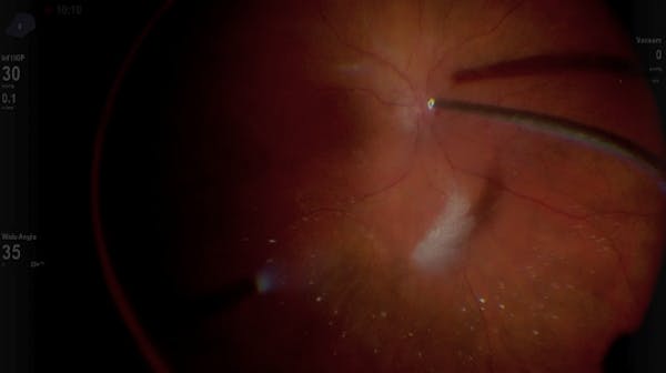Macular Hole/Finesse Flex Loop w/ DATAFUSION thumbnail