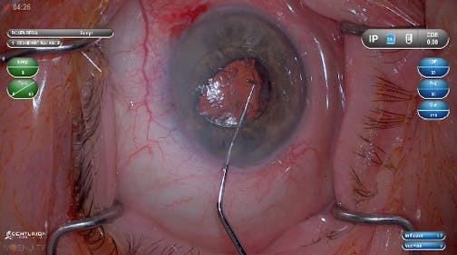 Dr. Rosenberg Iris Fixated PCIOL w/ DATAFUSION