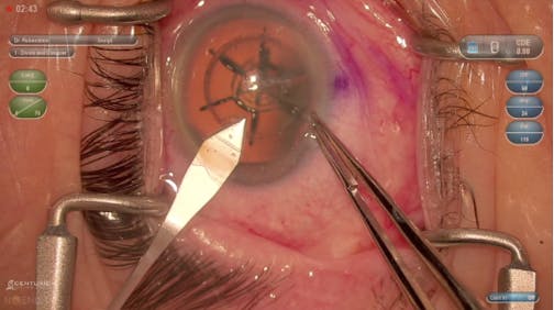 Femto Phaco w/ DATAFUSION