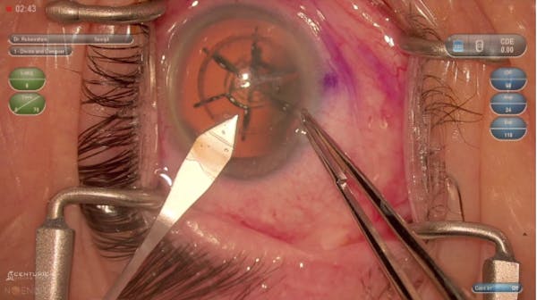 Femto Phaco w/ DATAFUSION thumbnail