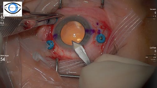 Dr. Singh Scleral Fixated IOL
