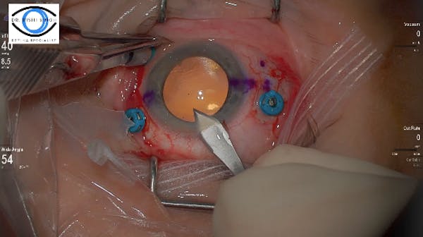 Dr. Singh Scleral Fixated IOL thumbnail