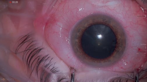 Dr. Eifrig 25G RRD w/ DATAFUSION