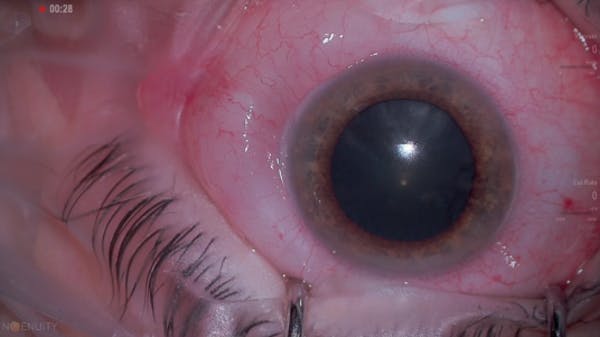 Dr. Eifrig 25G RRD w/ DATAFUSION thumbnail
