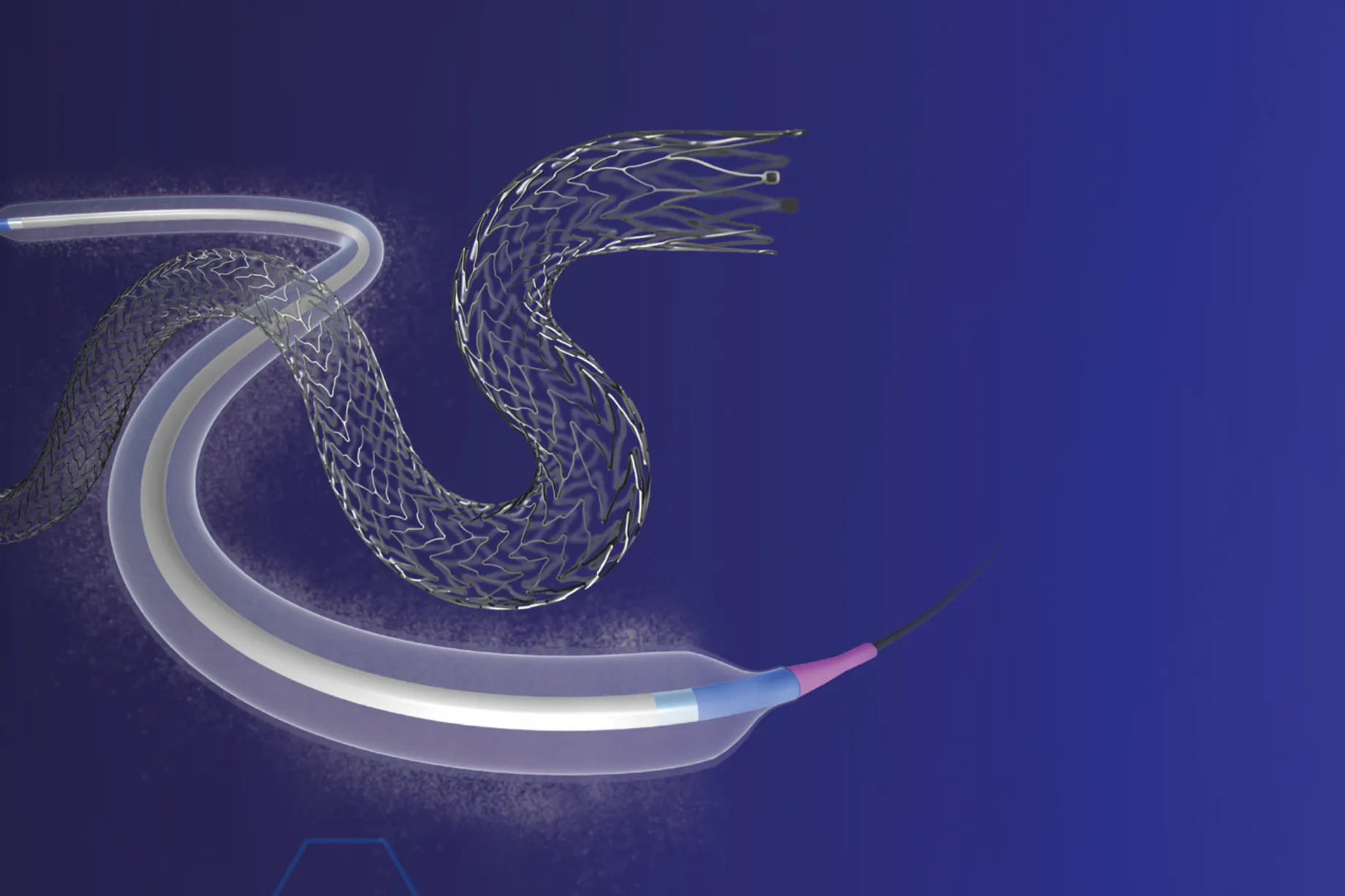 Extraluminal Device Examples iVascular’s Luminor and iVolution Devices Evaluated for Combined ...