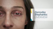 An Overview of <i>Demodex </i> Blepharitis