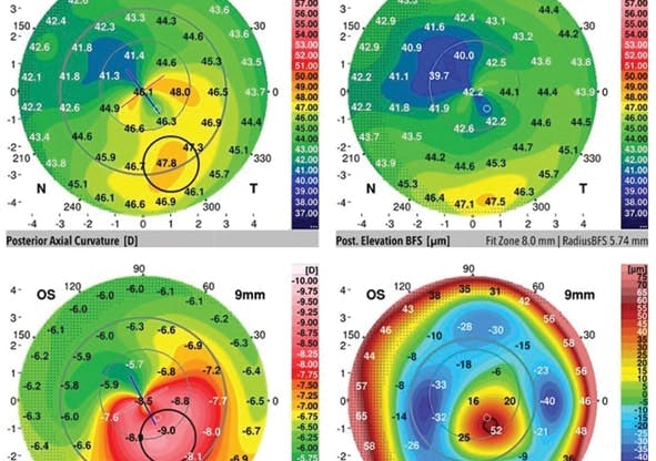 The Art and Science of Managing Post-LASIK Keratectasia - Modern Optometry