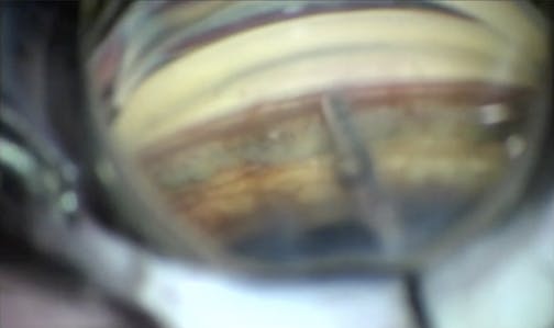 Procedure Using iAccess and iStent <em>inject</em> W