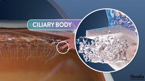 Understanding Fluid Circulation and Glaucoma