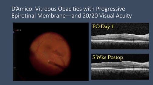 Surgery for Vitreous Opacities in a 20/20 Patient With ERM