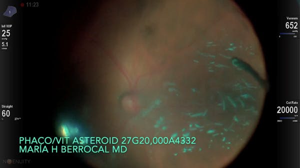 27-Gauge Phacovitrectomy in a Patient With Dense Cataract, Asteroid Hyalosis, and Vitreous Opacities thumbnail