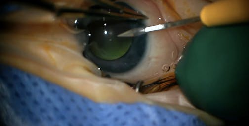 Vasculopathy and ADNIV