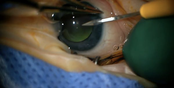 Vasculopathy and ADNIV thumbnail