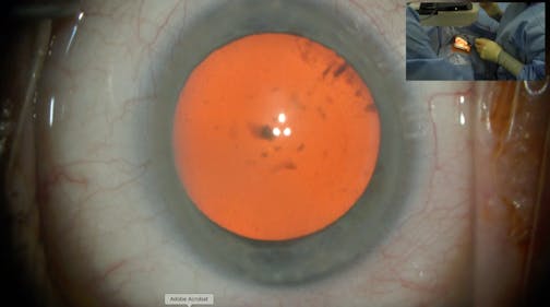 Start to Finish Phacoemulsification Procedure with Dr. Eva Liang