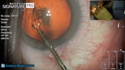 Eye Wash to Suture Phacoemulsification Procedure with Dr. Eva Liang