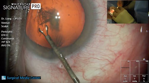 Eye Wash to Suture Phacoemulsification Procedure with Dr. Eva Liang