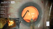 CATALYS<sup>®</sup> Precision Laser System and Phacoemulsification with Dr. Eva Liang