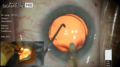 CATALYS<sup>®</sup> Precision Laser System and Phacoemulsification with Dr. Eva Liang