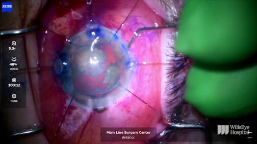 Dense Cataract in Pseudoexfoliation Syndrome