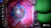 Dense Cataract in Pseudoexfoliation Syndrome