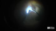 Surgery for an Infant With Stage-5 Familial Exudative Vitreoretinopathy