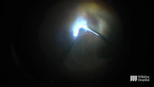 Surgery for an Infant With Stage-5 Familial Exudative Vitreoretinopathy
