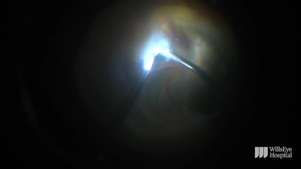 Surgery for an Infant With Stage-5 Familial Exudative Vitreoretinopathy thumbnail