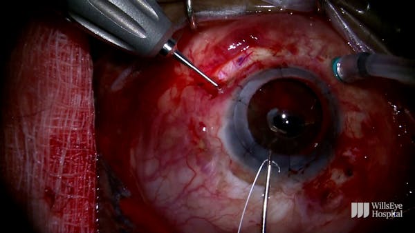 A Complex Case of Cornea Transplant and IOL Exchange thumbnail