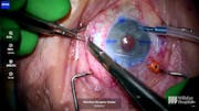 Repeat DSEK Combined With IOL Removal and Secondary IOL With Scleral Fixation