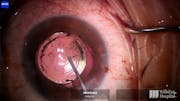 IOL Reposition in Setting of Extensive Synechiae
