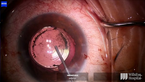 IOL Reposition in Setting of Extensive Synechiae thumbnail